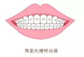 當(dāng) 整牙 成為一種潮流,矯牙前最該考慮這4個問題